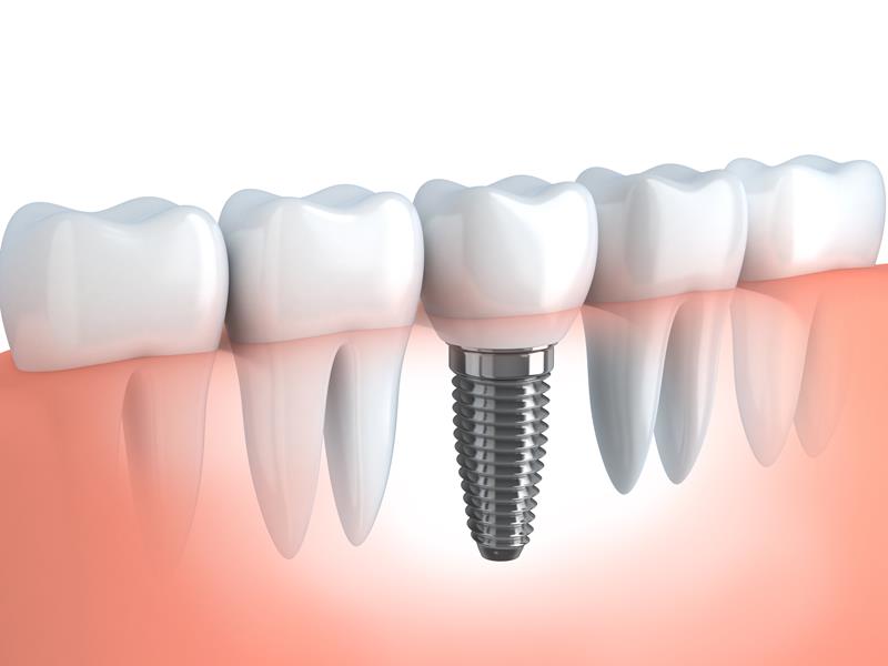 Dental Implants  Lilburn, GA  