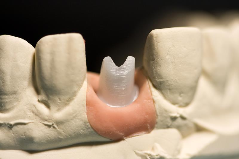 Implant Restoration  Lilburn, GA  